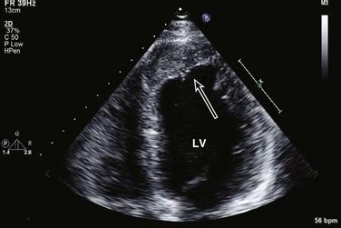 layered apical thrombus.